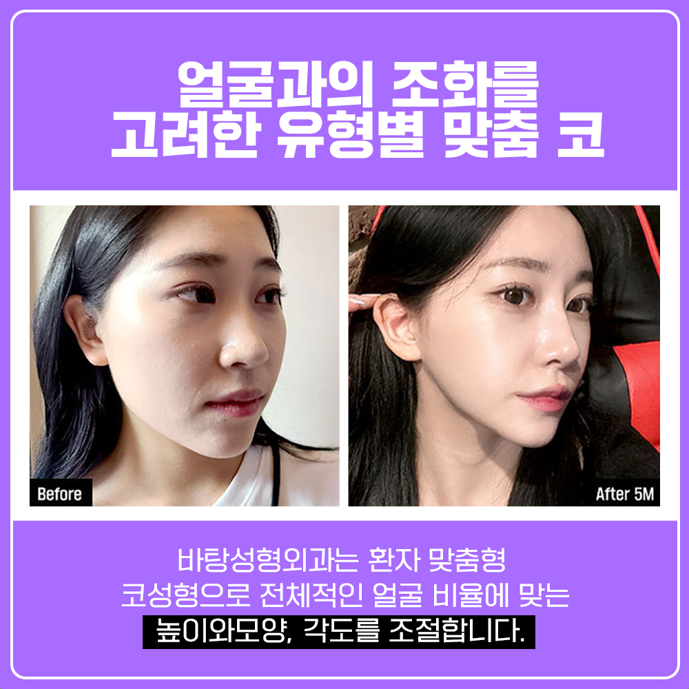 바탕-코성형비용-코수술보형물.jpg