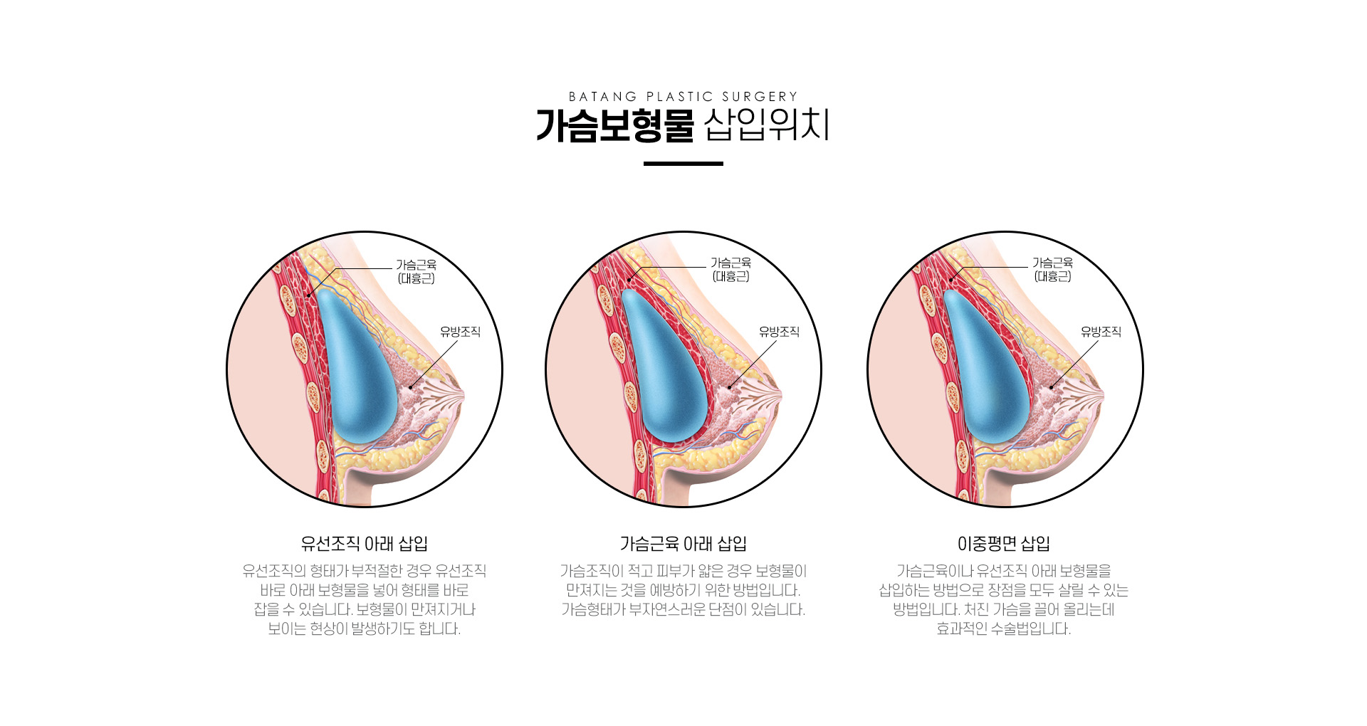 바탕가슴성형