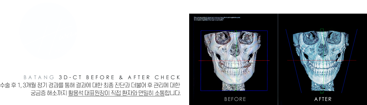 바탕성형외과 안면윤곽의 특별함