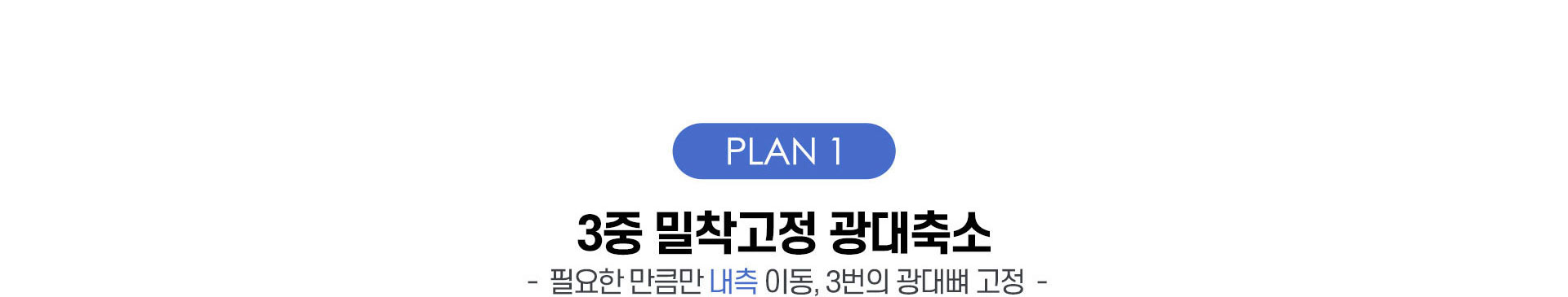 3중밀착고정광대축소, 필요한 만큼만 내측 이동, 3번의 광대뼈 고정