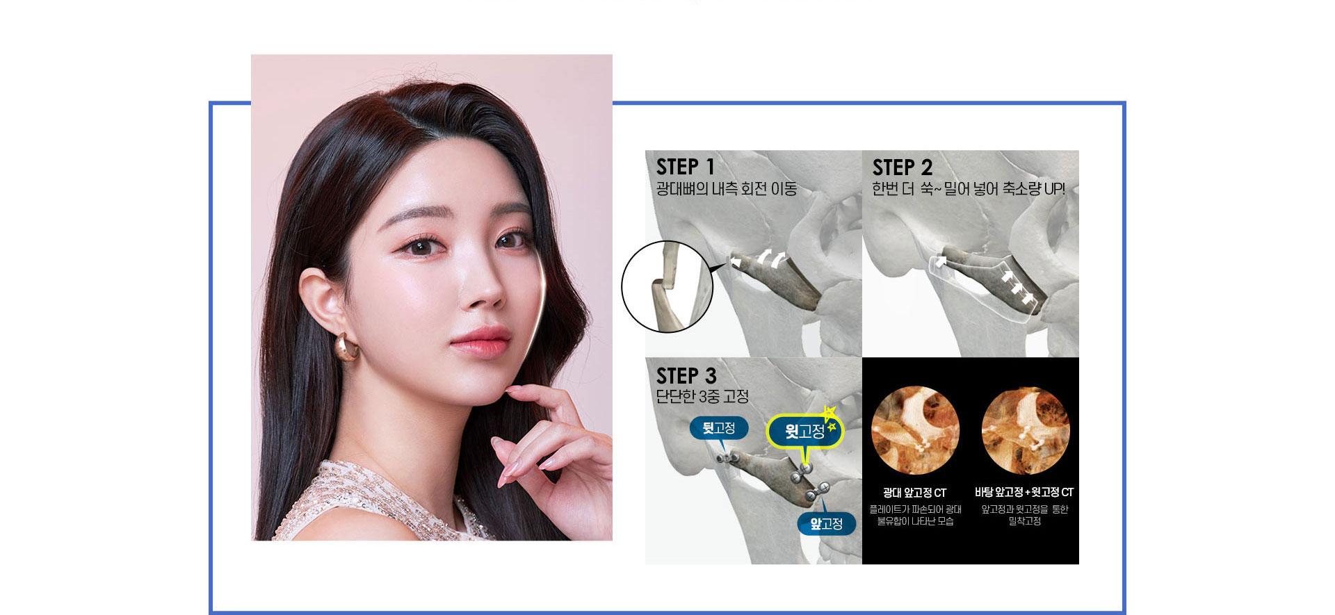안면윤곽, 뒷고정, 윗고정, 앞고정
