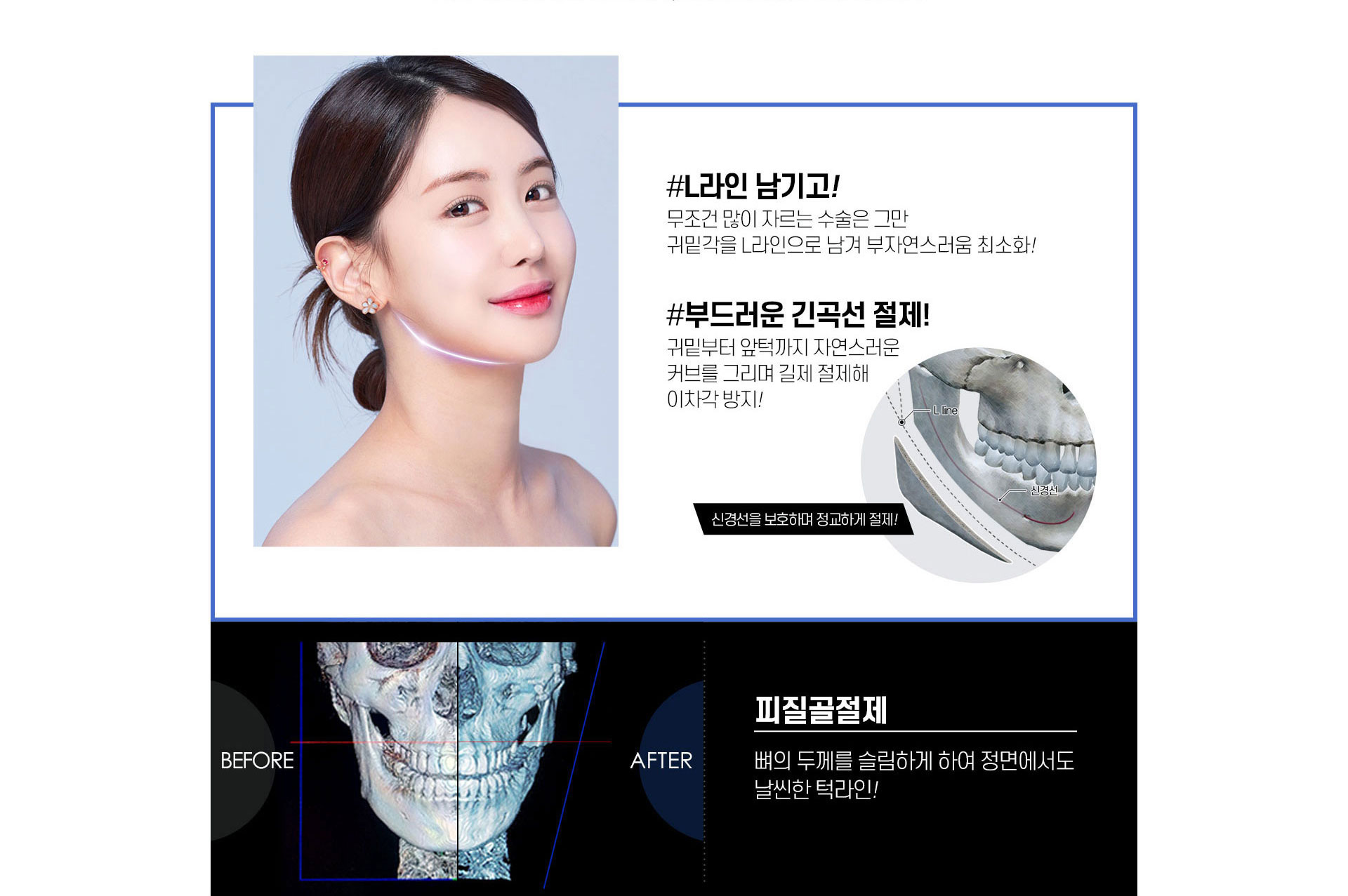 L라인 남기고, 부드러운 긴곡선 절제, 피질골절제