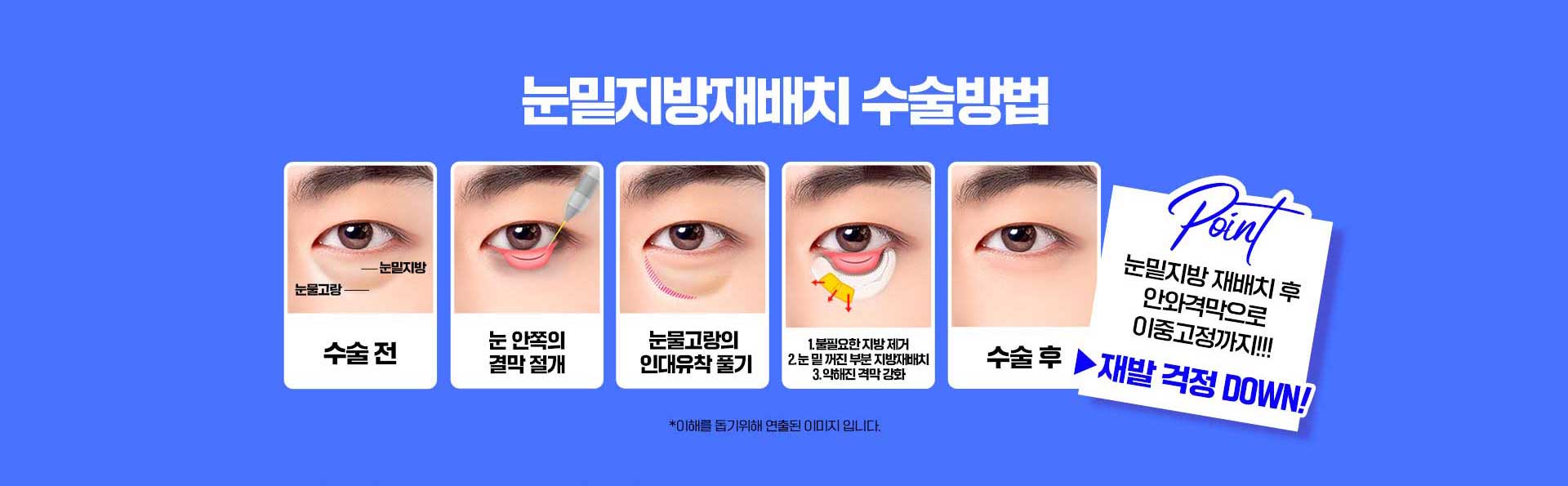 바탕남자눈성형외과