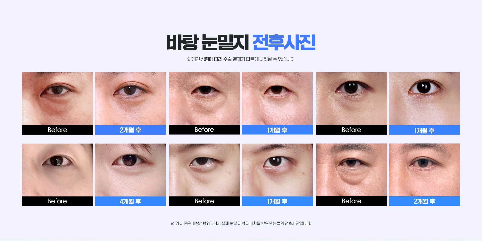 바탕남자눈성형외과