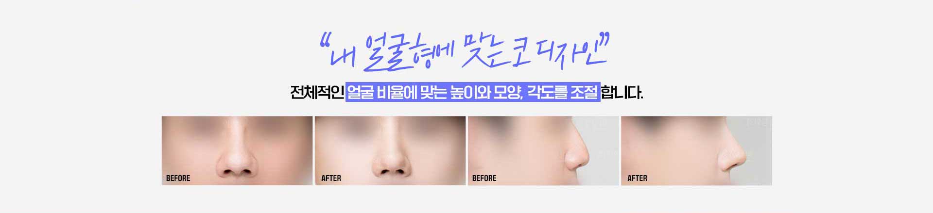 바탕남자코성형