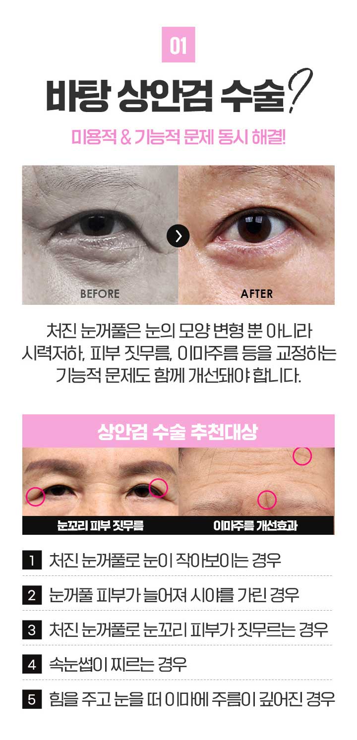 상안검수술