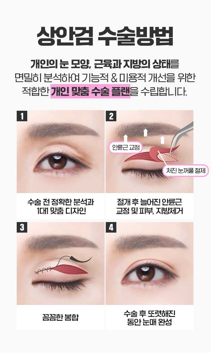 상안검수술