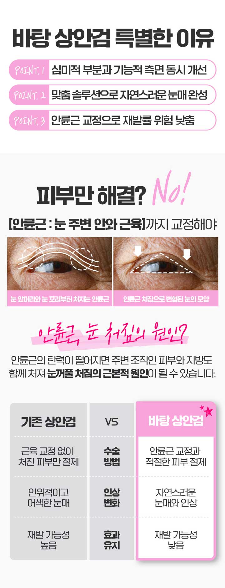 상안검수술