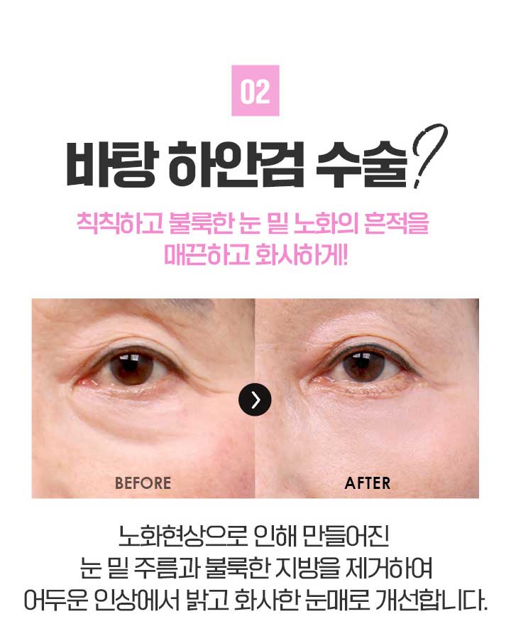 상안검수술