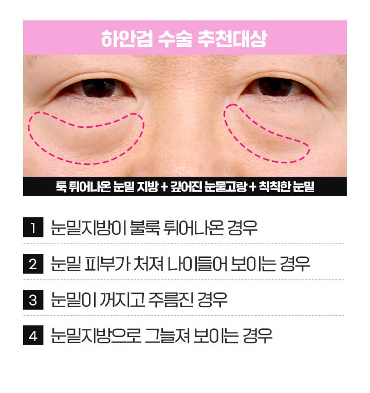 상안검수술