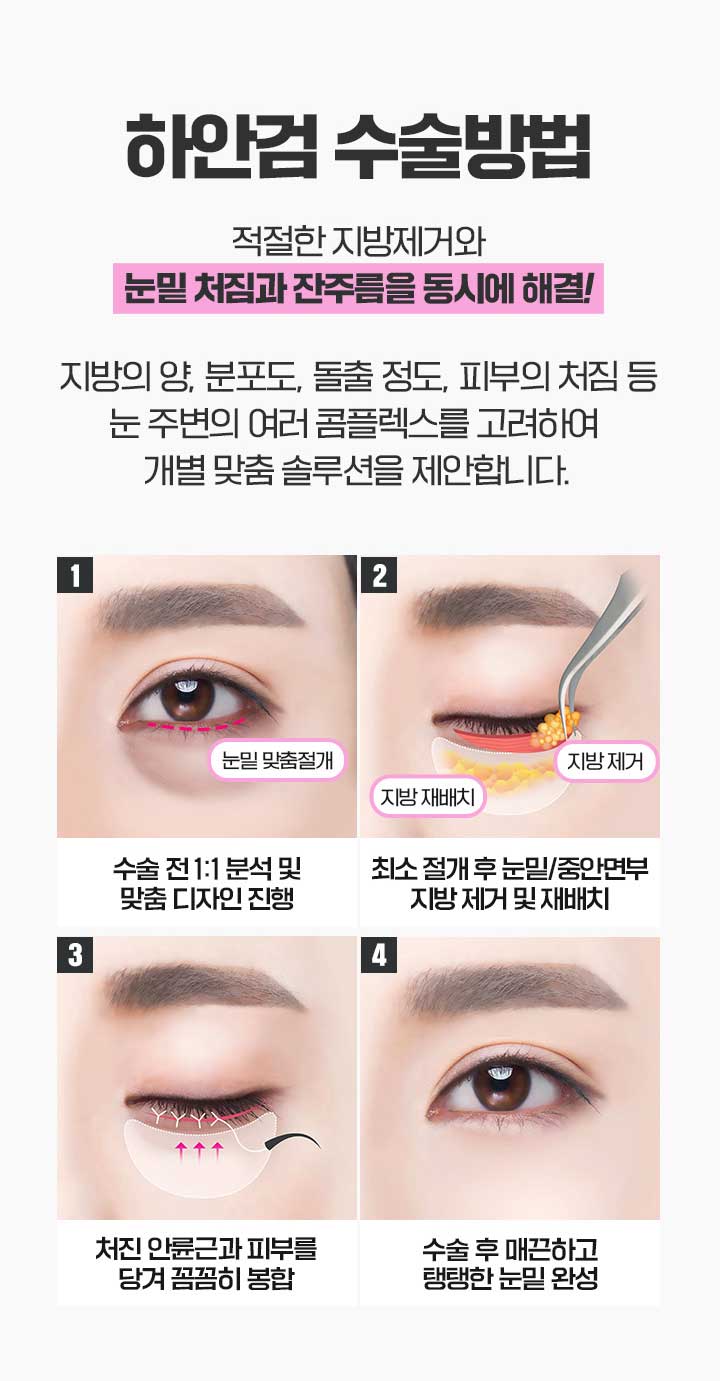 상안검수술