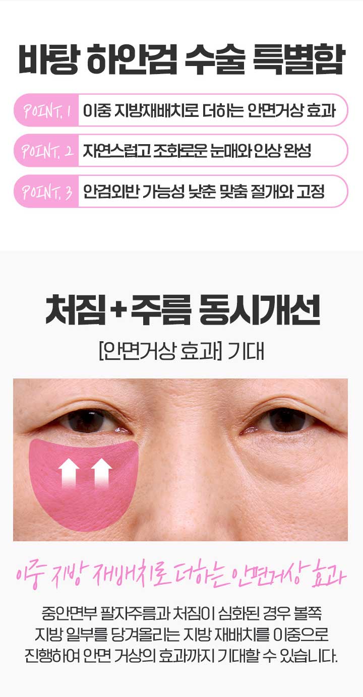 상안검수술