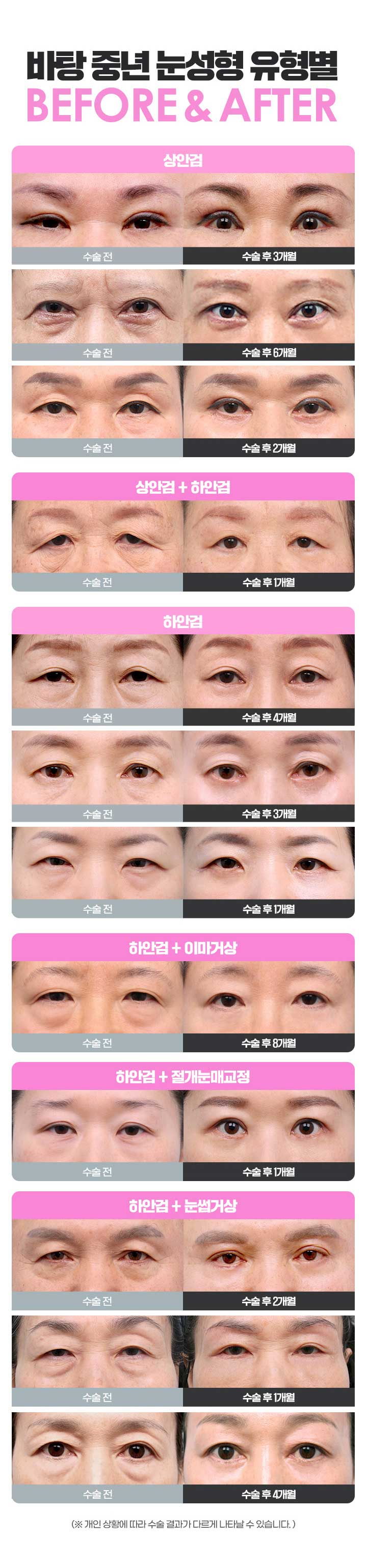 상안검수술