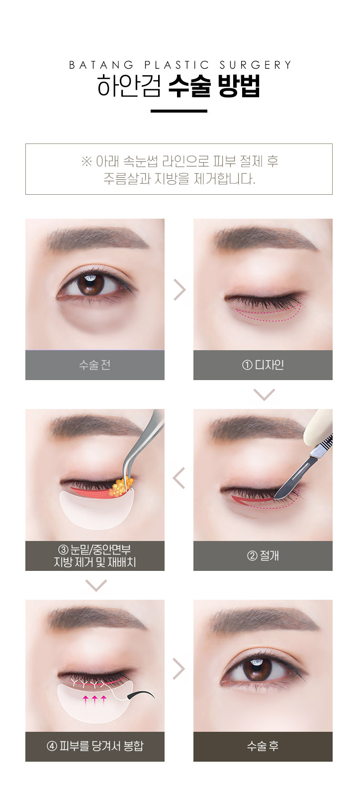 중년눈성형