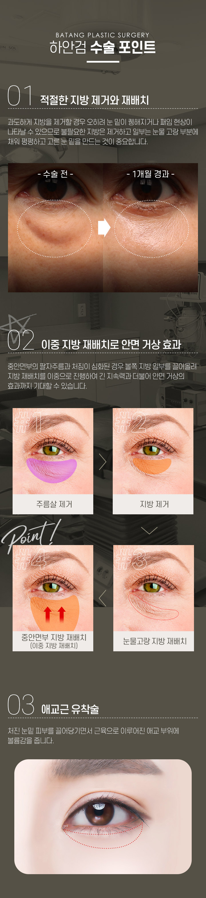 중년눈성형