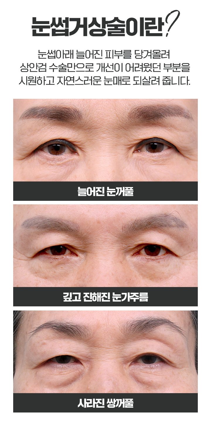 중년눈성형
