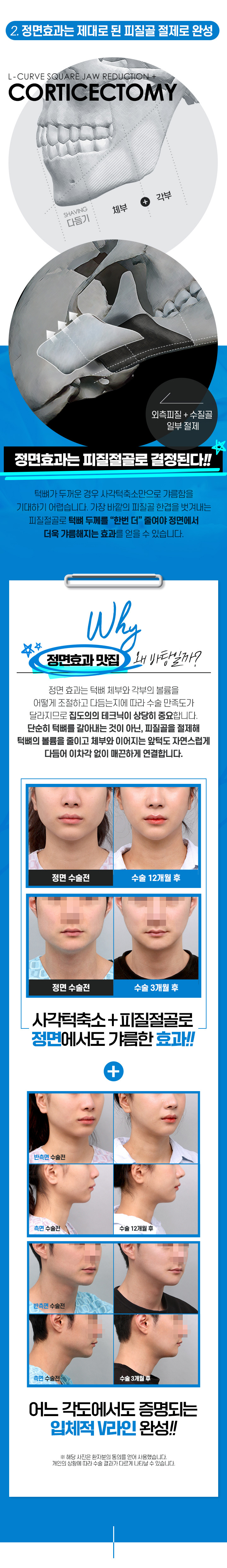 L커브 사각턱축소의 특징