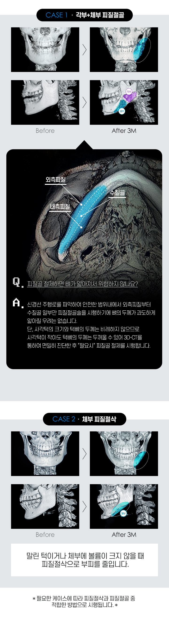 L커브 사각턱축소의 특징