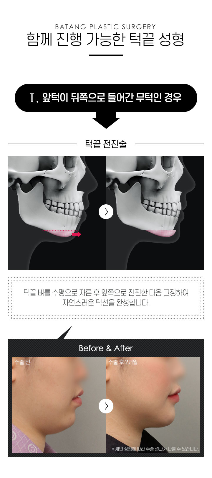 턱끝성형