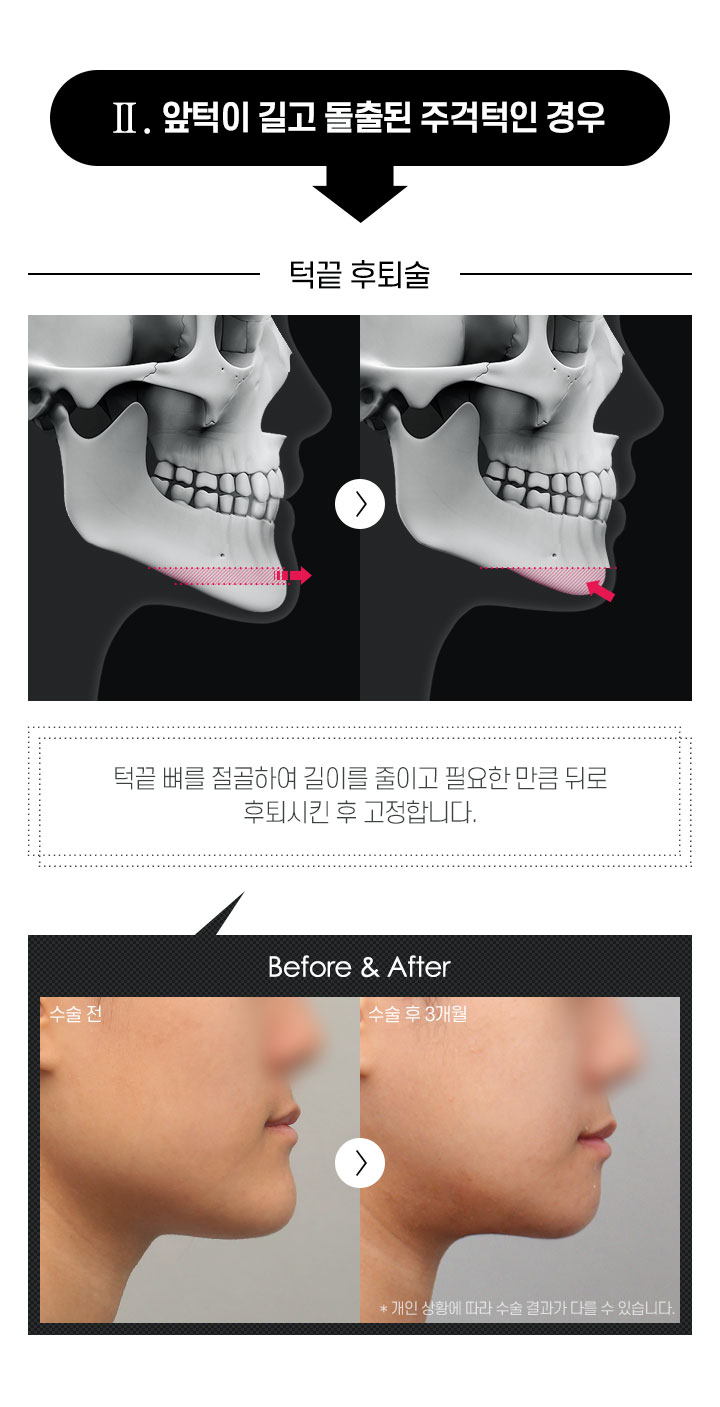 턱끝성형