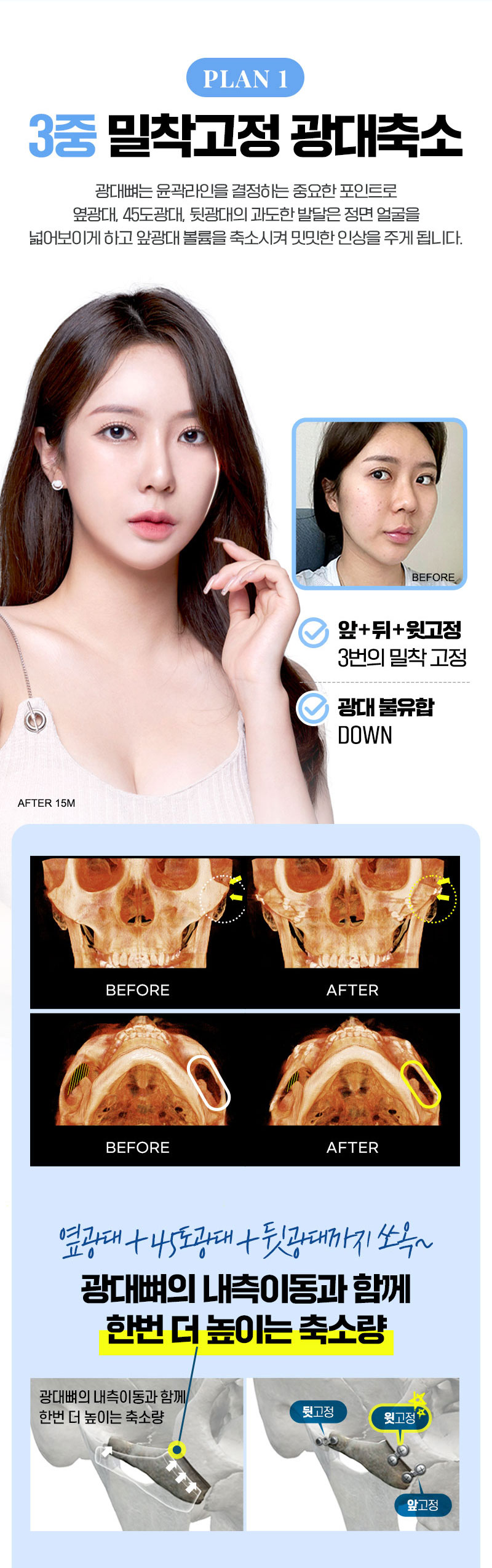 윗고정,왜필요할까요, 골막재고정,3중밀착고정