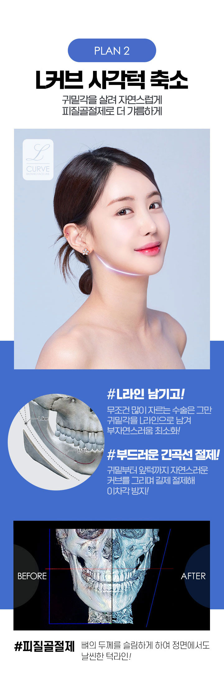 L커브사각턱축소, 귀밑각을 살려 자연스럽게, 피질골절제로 더 갸름하게