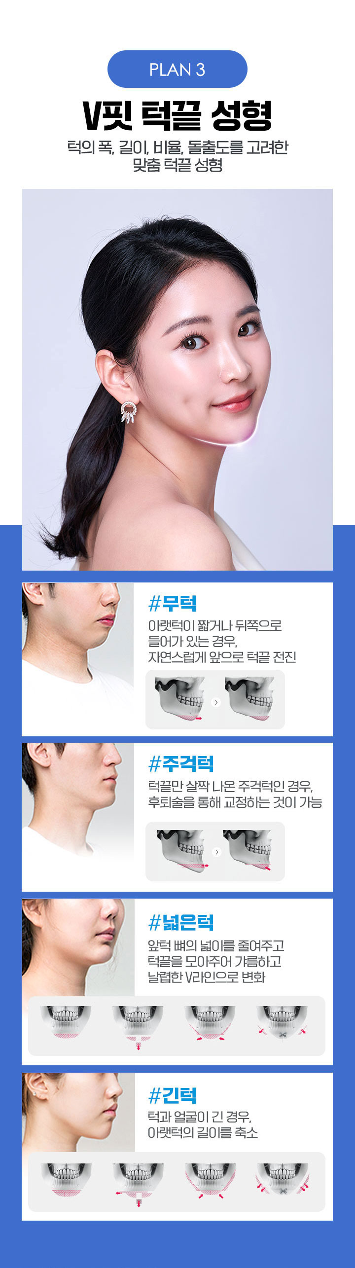 V핏 턱끝 성형, 턱의 폭,길이,비율,돌출도를 고려한 맞춤 턱끝성형