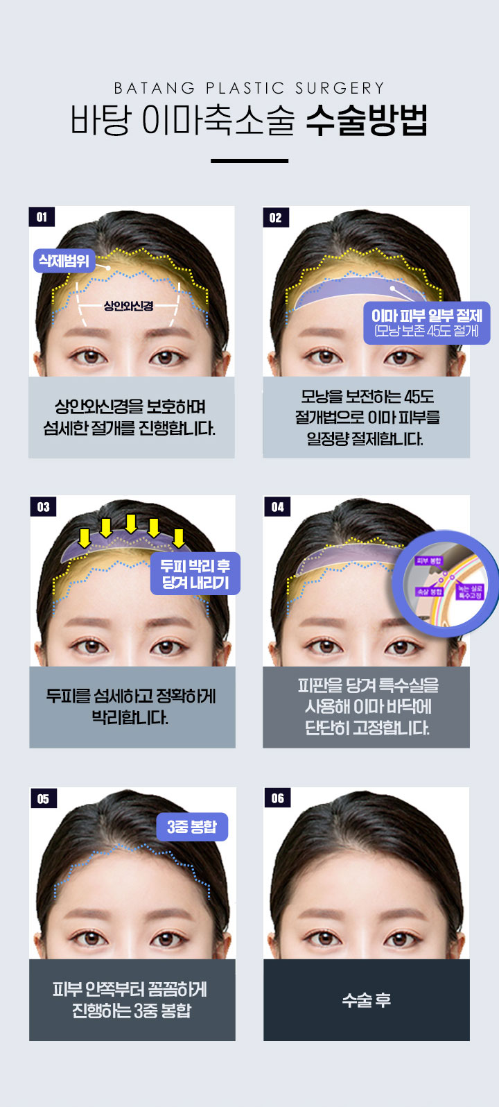 이마축소술